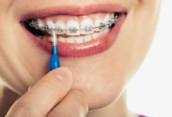 Профессиональный уход за полостью рта во время ортодонтического лечения